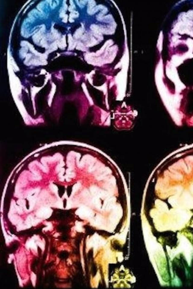 Лекція Галини Скибо. Нейродегенеративні захворювання: хвороби Альцгеймера, Паркінсона та розсіяний склероз